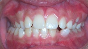Dental Midlines Lafayette Orthodontics Lafayette CA