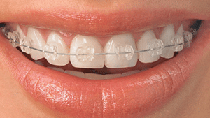 Clear Braces: What Are They? - Karrie Chu DDS Dental Care Pasadena  California