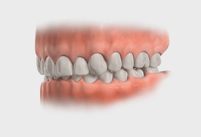 Overbite Lafayette Orthodontics in Lafayette, CA