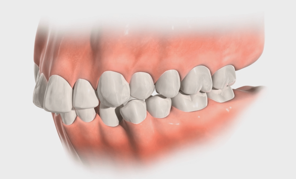 Protrusion Lafayette Orthodontics in Lafayette, CA