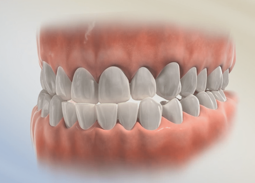 Underbite Lafayette Orthodontics in Lafayette, CA