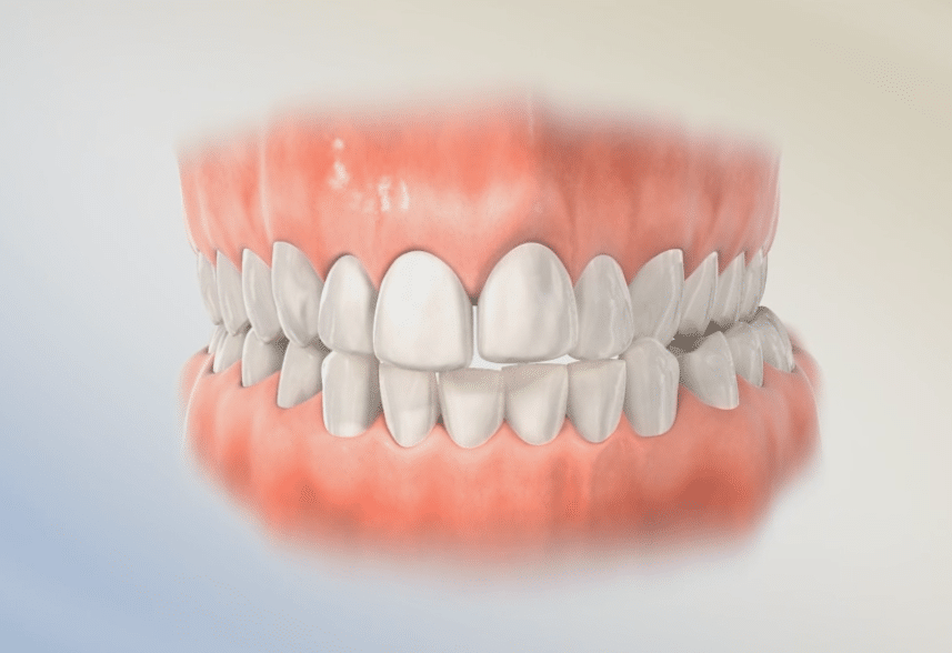 Crossbite Lafayette Orthodontics in Lafayette, CA