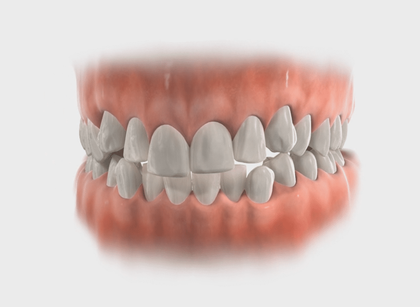 Crowding Lafayette Orthodontics in Lafayette, CA