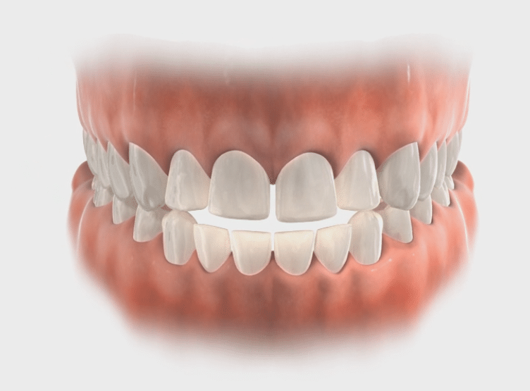 Open Bite Lafayette Orthodontics in Lafayette, CA