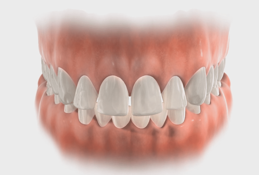 Spacing Lafayette Orthodontics in Lafayette, CA